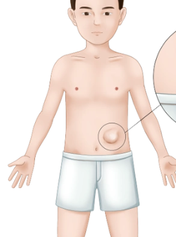 自触腹部包块多已>5cm,恶性肿瘤进展期常见