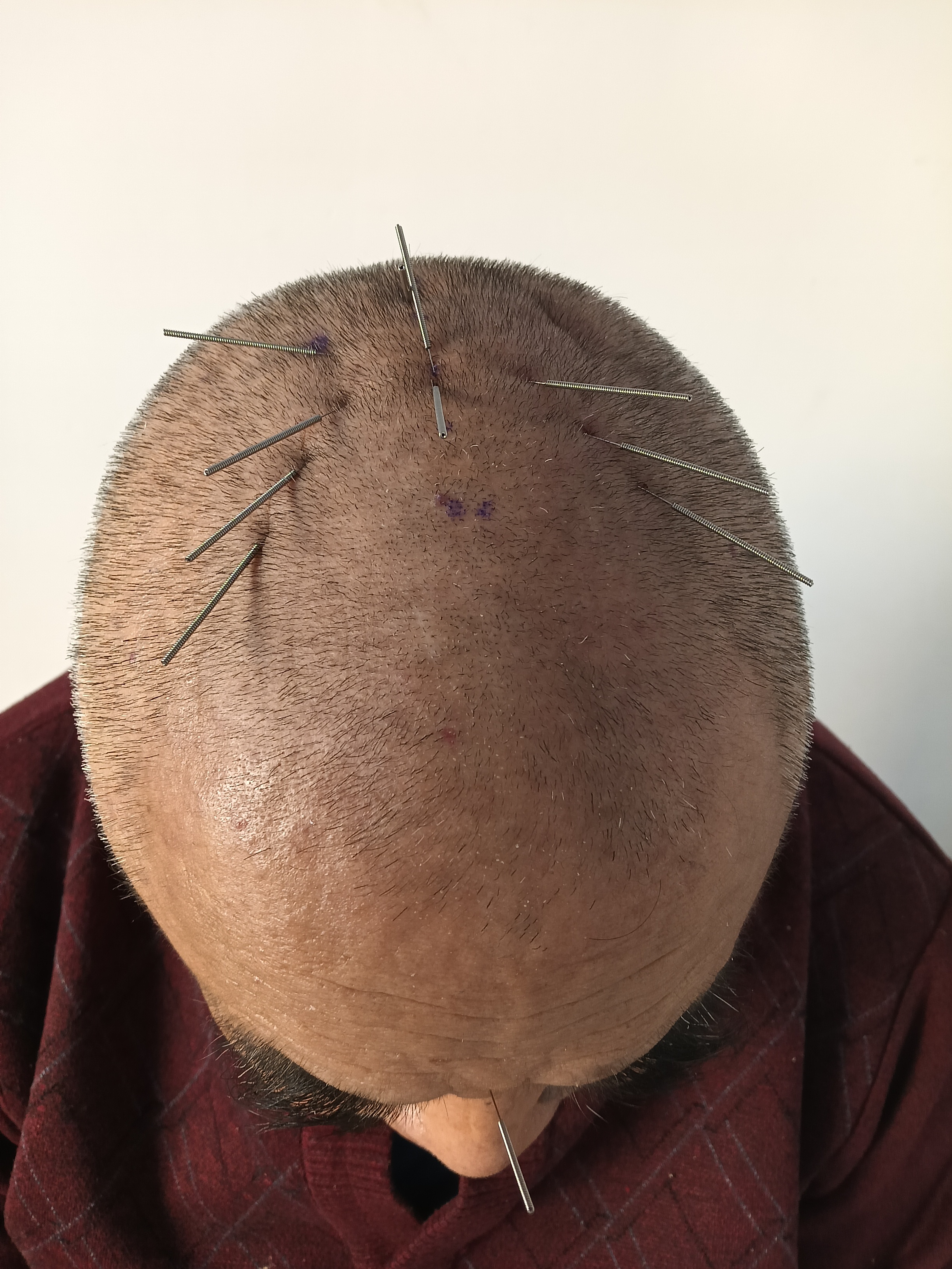 针灸,这一源自中国的传统医术,以其独特的理论和治疗方法,在调节人体