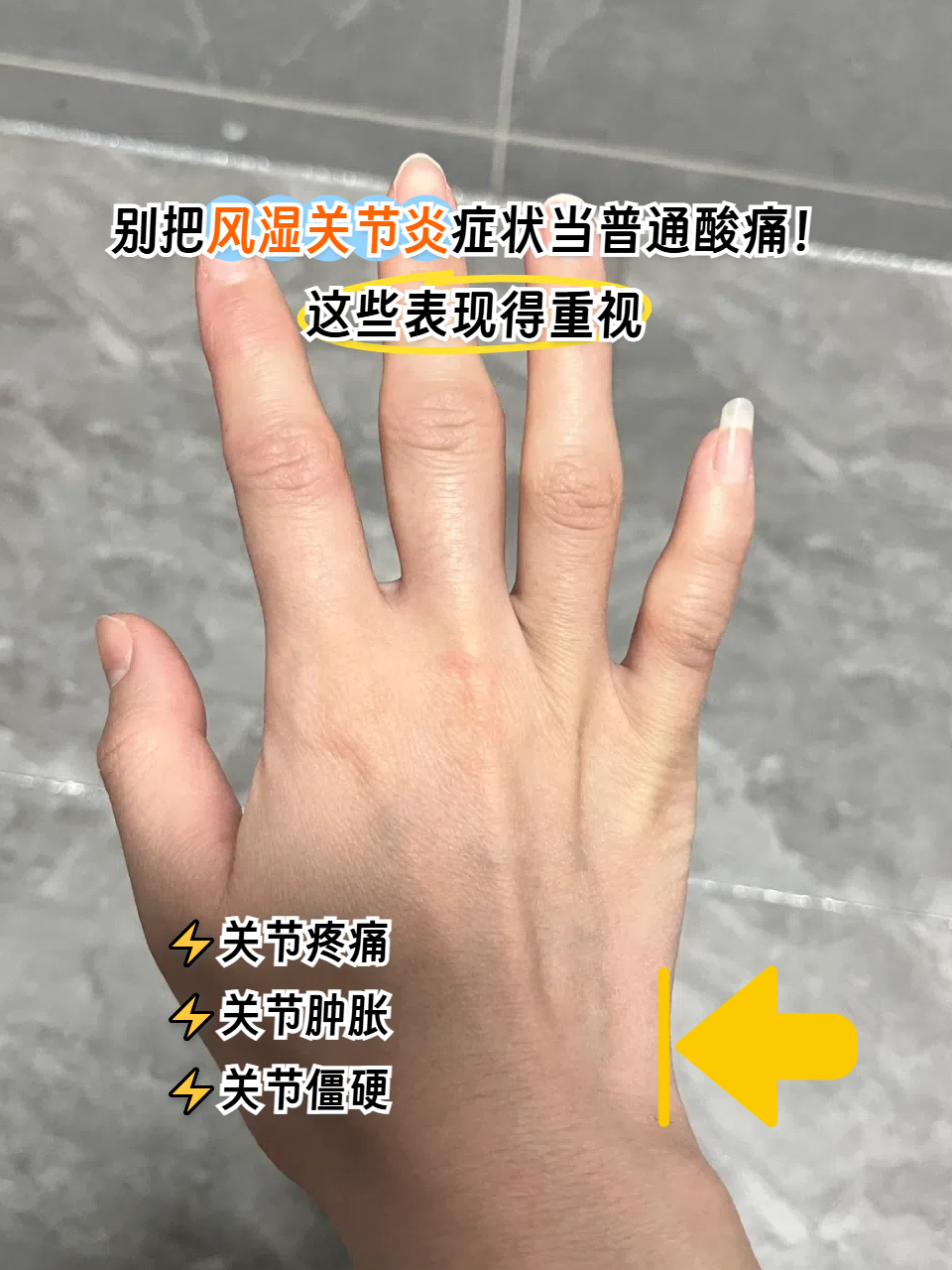 别把风湿关节炎症状当普通酸痛!