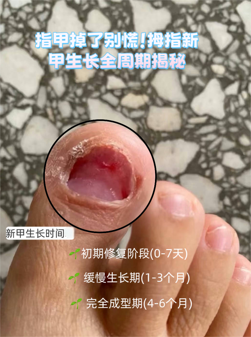 这其实是常见的甲床损伤现象～今天就来详细说说新指甲生长的全过程