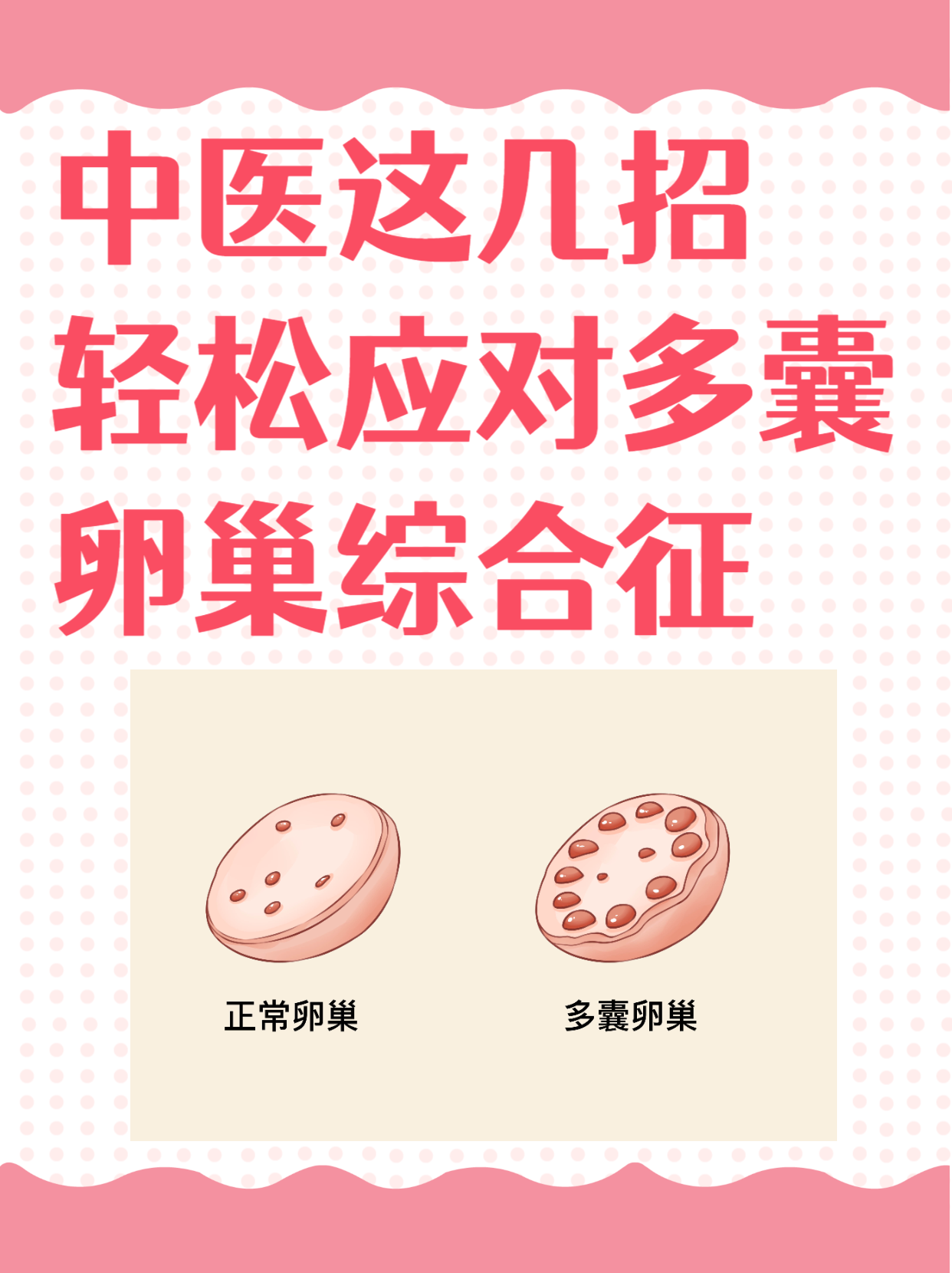 多卵巢多囊可以治吗(多卵巢多囊综合症好治疗吗)