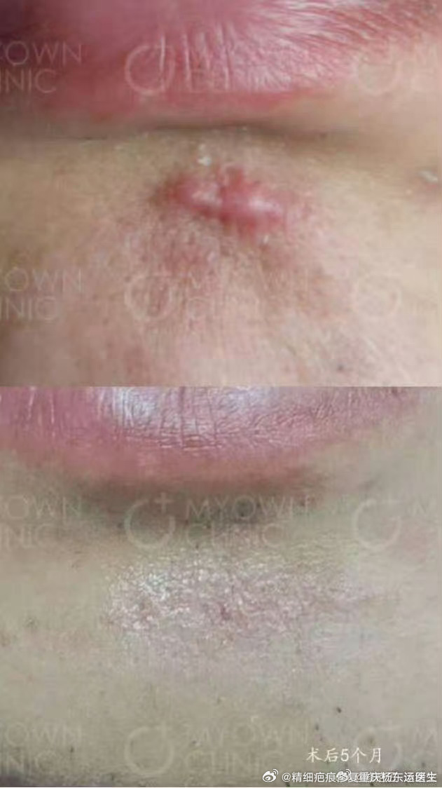 对于这种增生疤痕,如果只是想不增生就行,非手术治疗是可以的,但如果