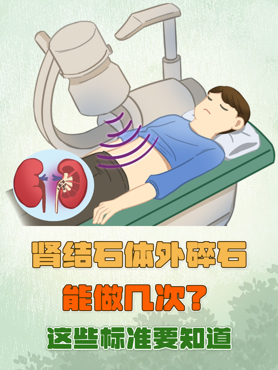 体外碎石