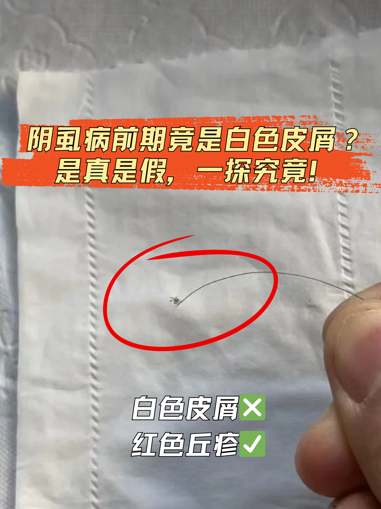 阴虱病其实是由寄生在人体毛发上的阴虱引起的一种传染性皮肤病