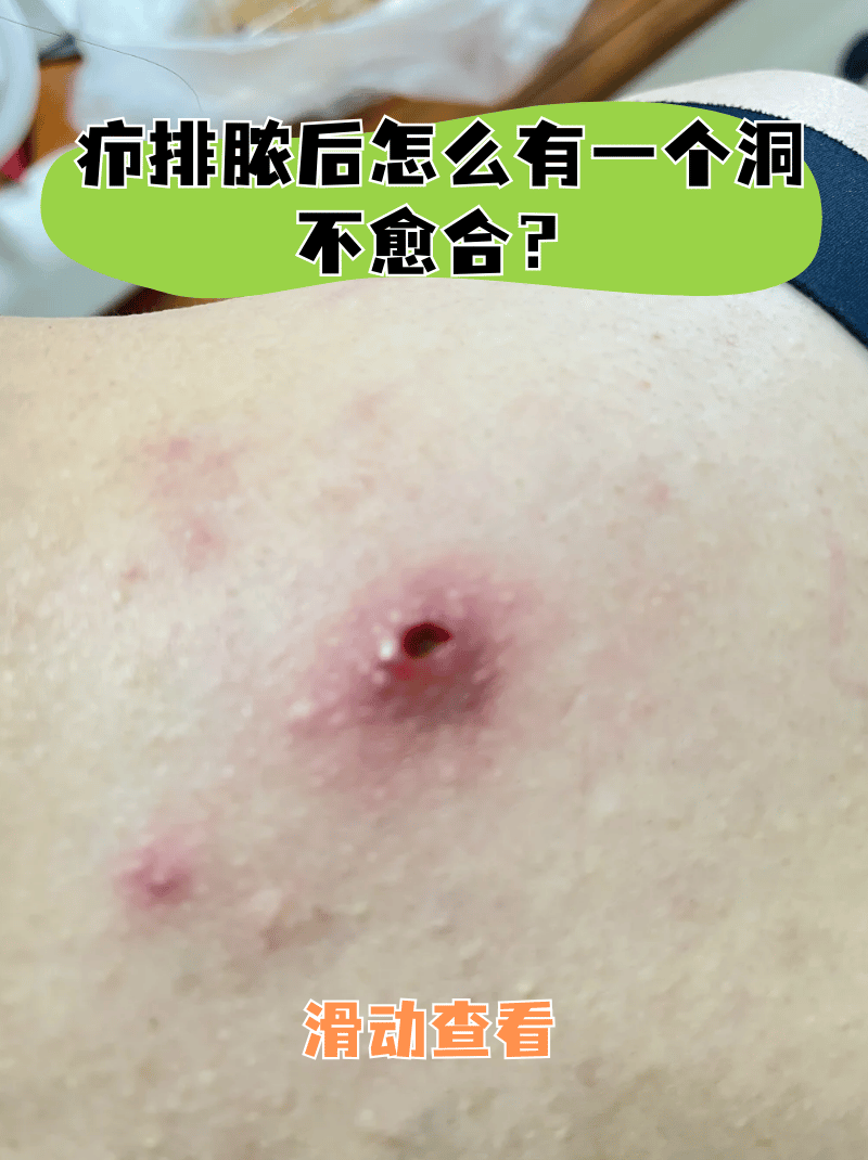 疖子排脓后怎么有一个洞不愈合?