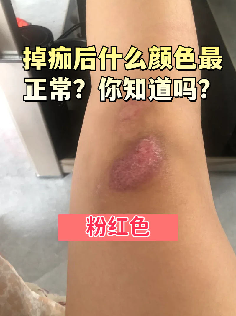 伤口为什么会结痂脱落为什么在线 伤口为什么会结痂脱落为什么在线