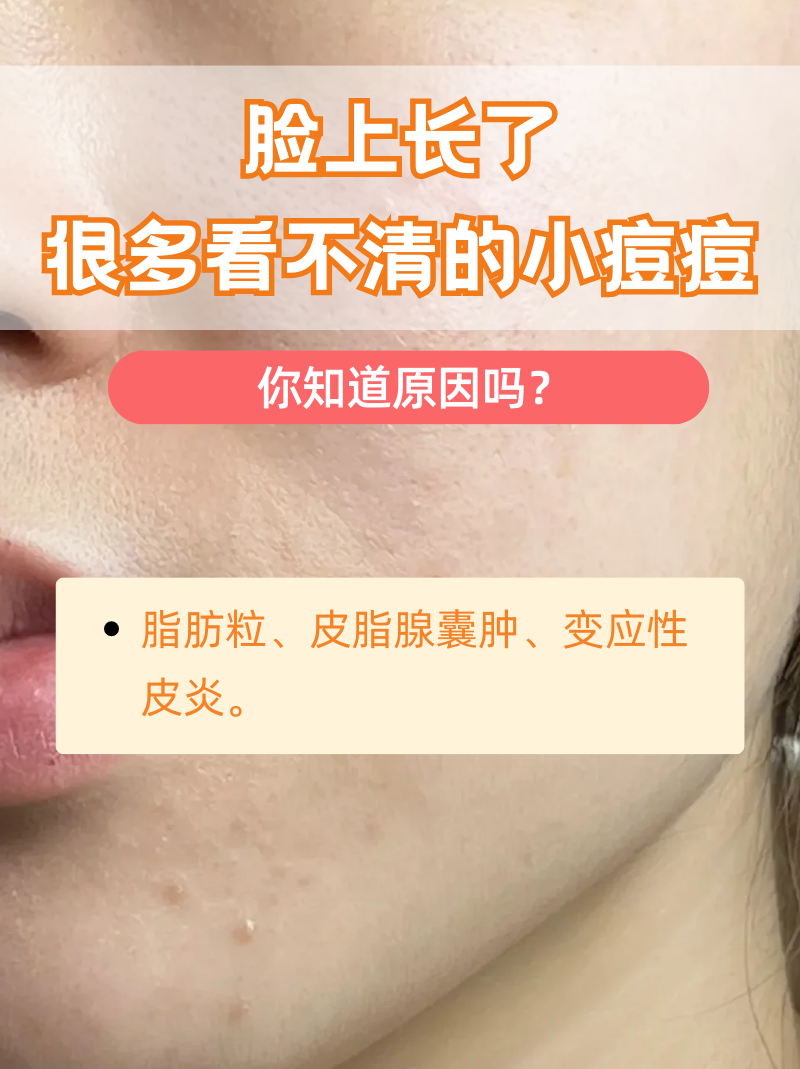 脂肪粒为什么会长