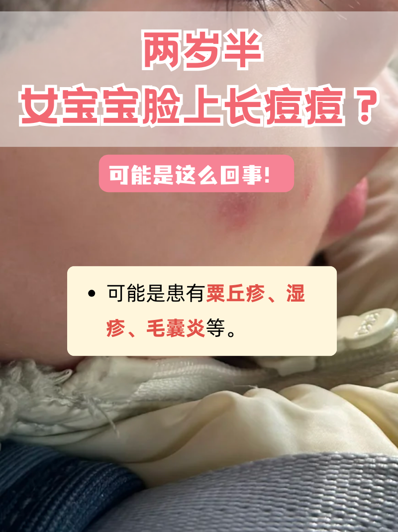 如果两岁半女宝宝脸上出现长痘痘的情况,可能由粟丘疹,湿疹,毛囊炎等