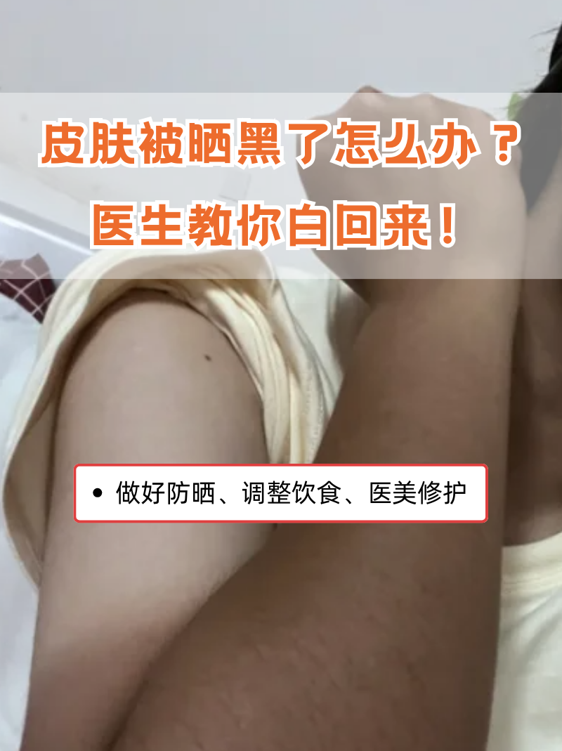 为什么容易晒黑