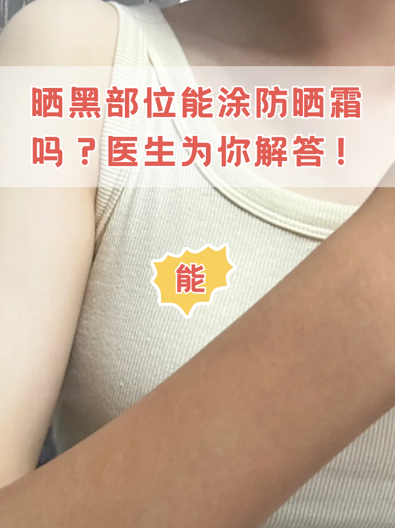 为什么有些人很容易晒黑为什么在线 为什么有些人很容易晒黑为什么在线