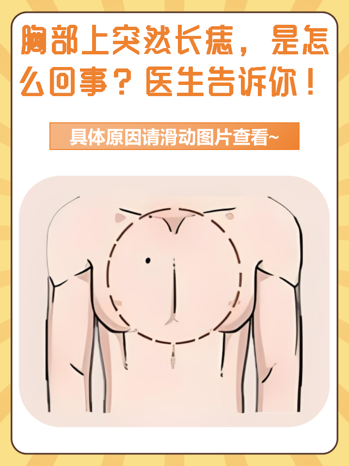 胸部上突然长痣,是怎么回事?医生告诉你!