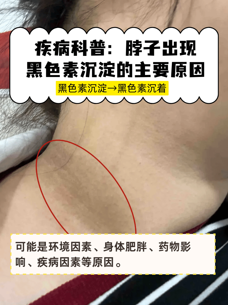 疾病科普:脖子出现黑色素沉淀的主要原因