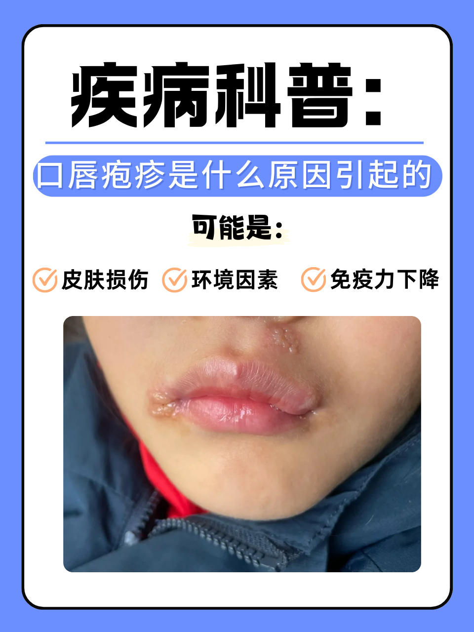 为什么会得唇炎 为什么会得唇炎