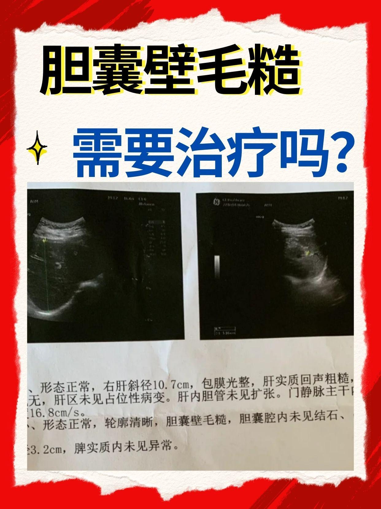 胆囊壁毛糙要治疗吗