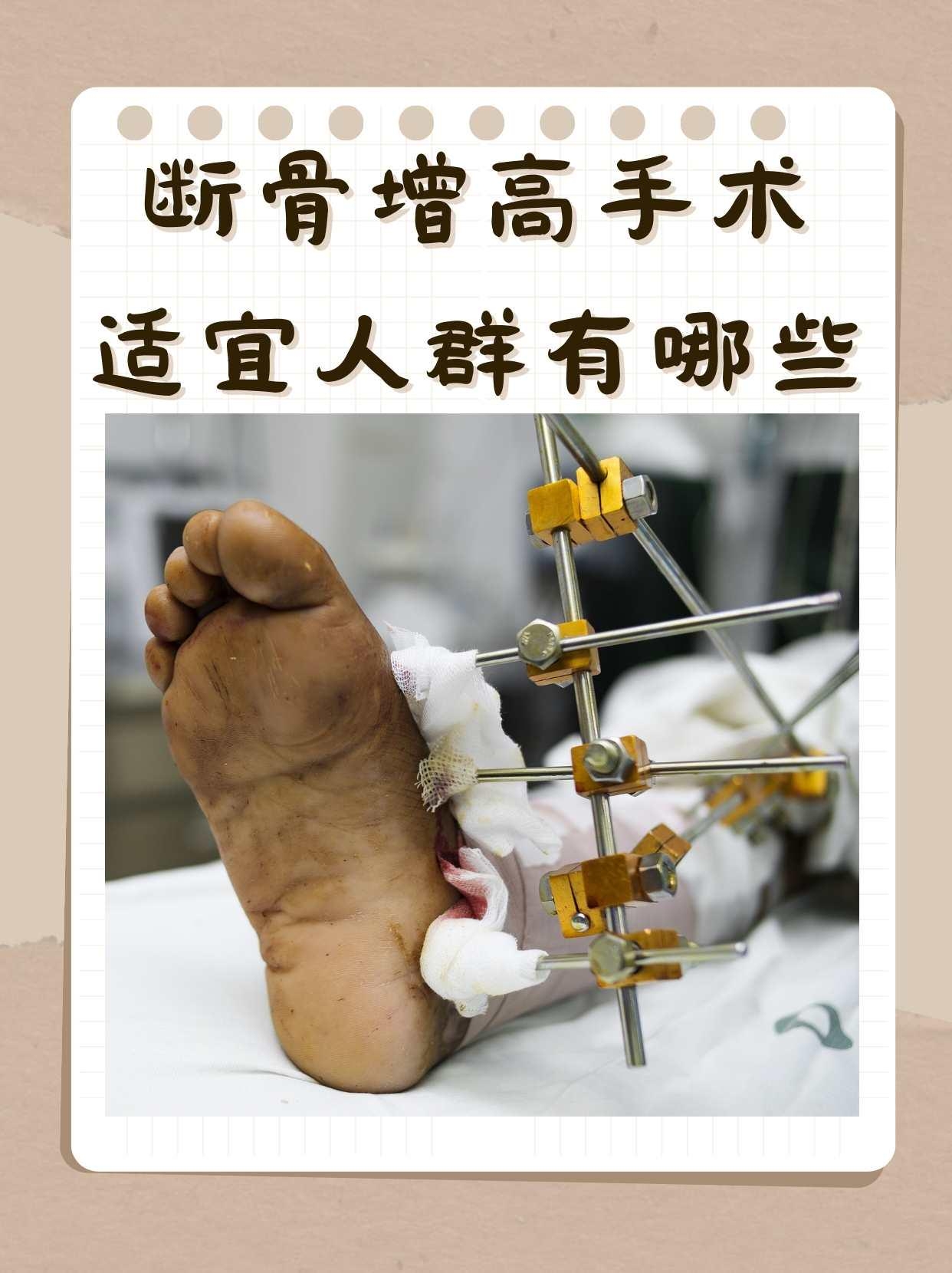 断骨增高手术适宜人群有哪些