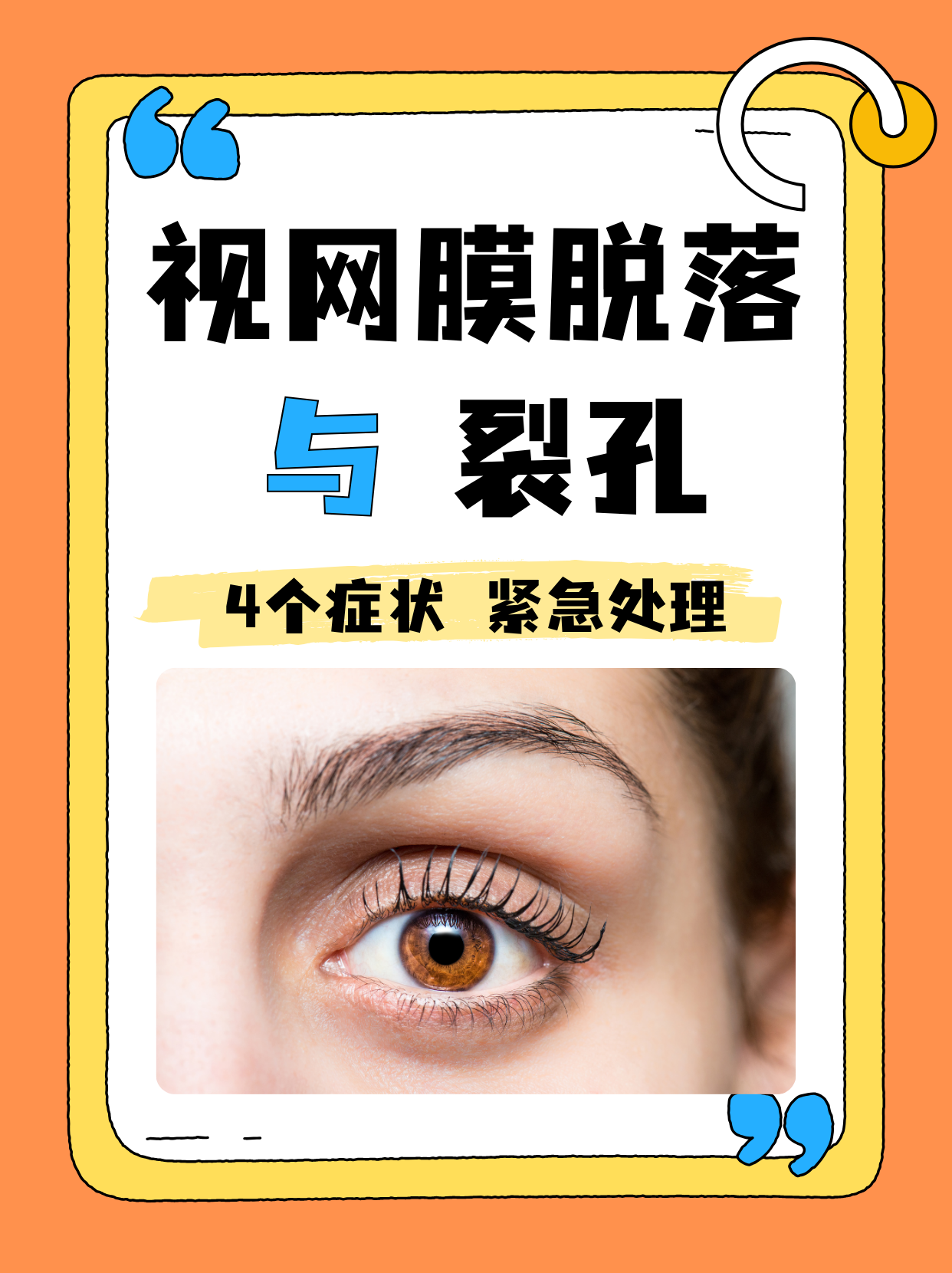 视网膜脱落与裂孔,4个症状,紧急处理!