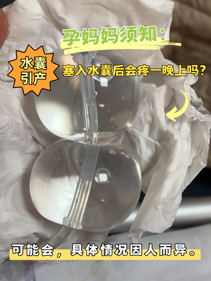 孕妈妈须知:水囊引产,塞入水囊后会疼一晚上吗?