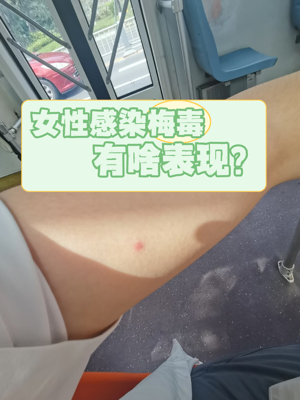 女性感染梅毒有啥表现?