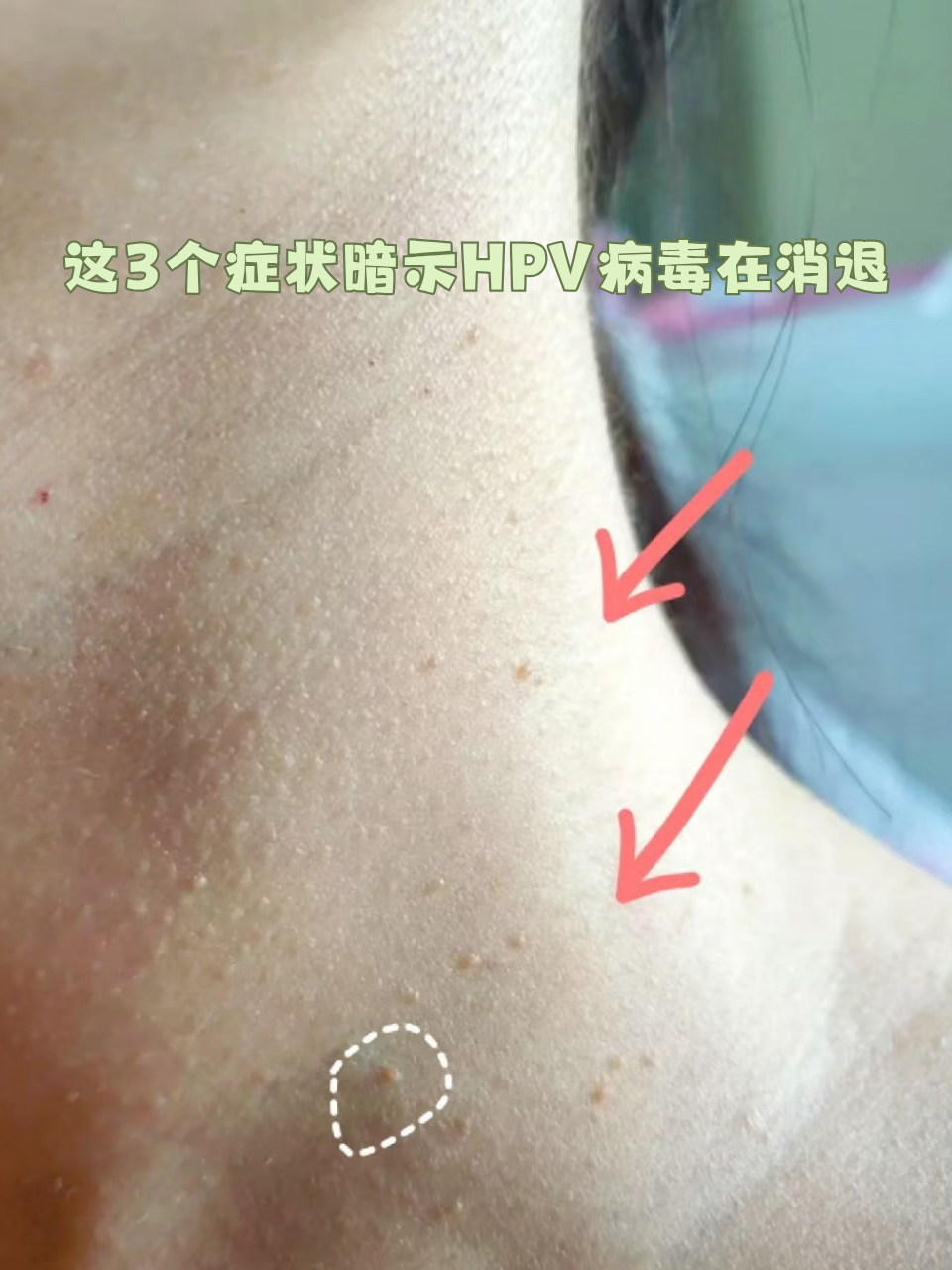 这3个症状暗示hpv病毒在消退