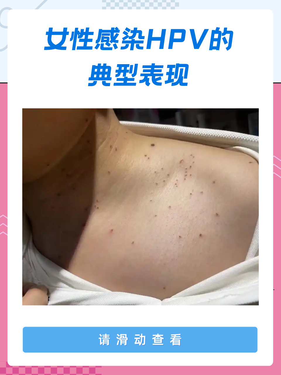 女性感染hpv的三种表现,助力每位女性守护健康