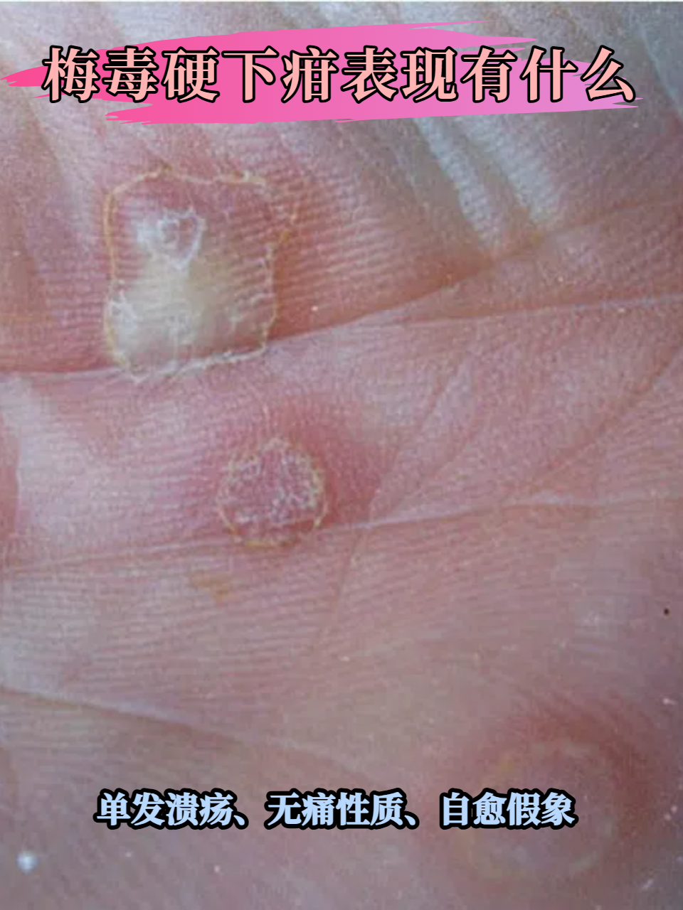 梅毒硬下疳表现有什么