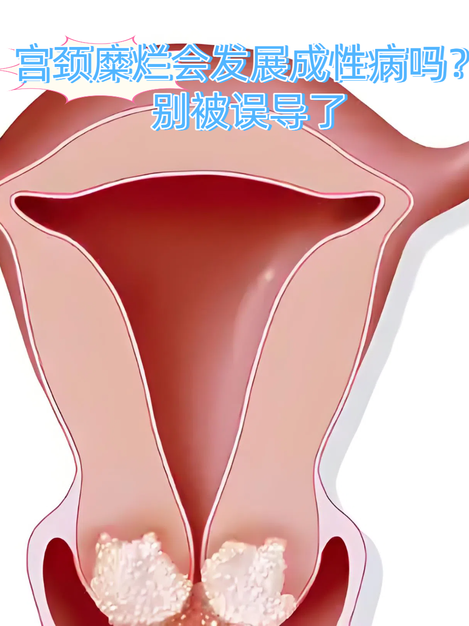 宫颈糜烂会发展成性病吗?