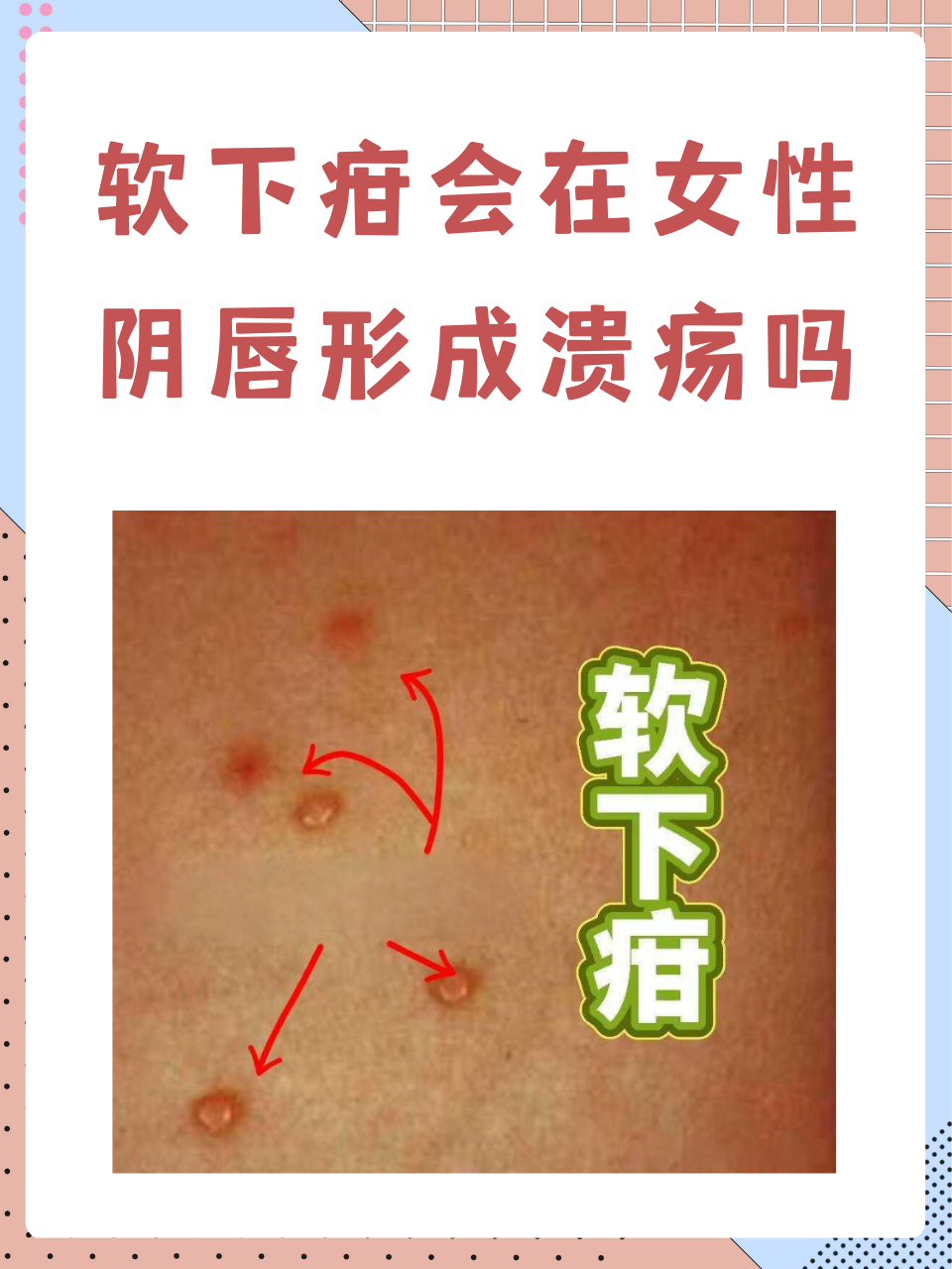 软下疳会在女性阴唇形成溃疡吗