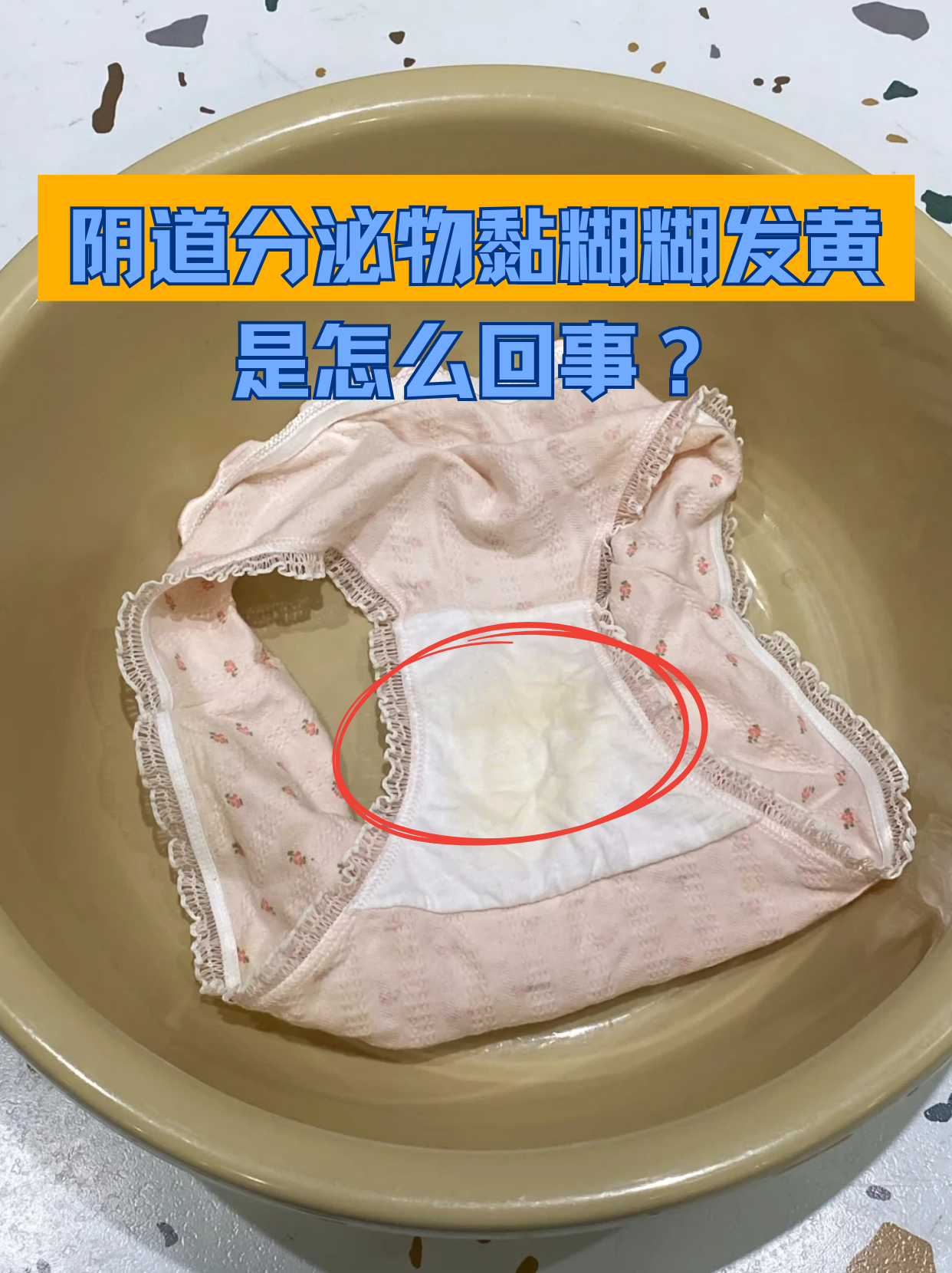 夏天不少女性发现内裤上的分泌物变得黏稠发黄,这可能是身体发出的