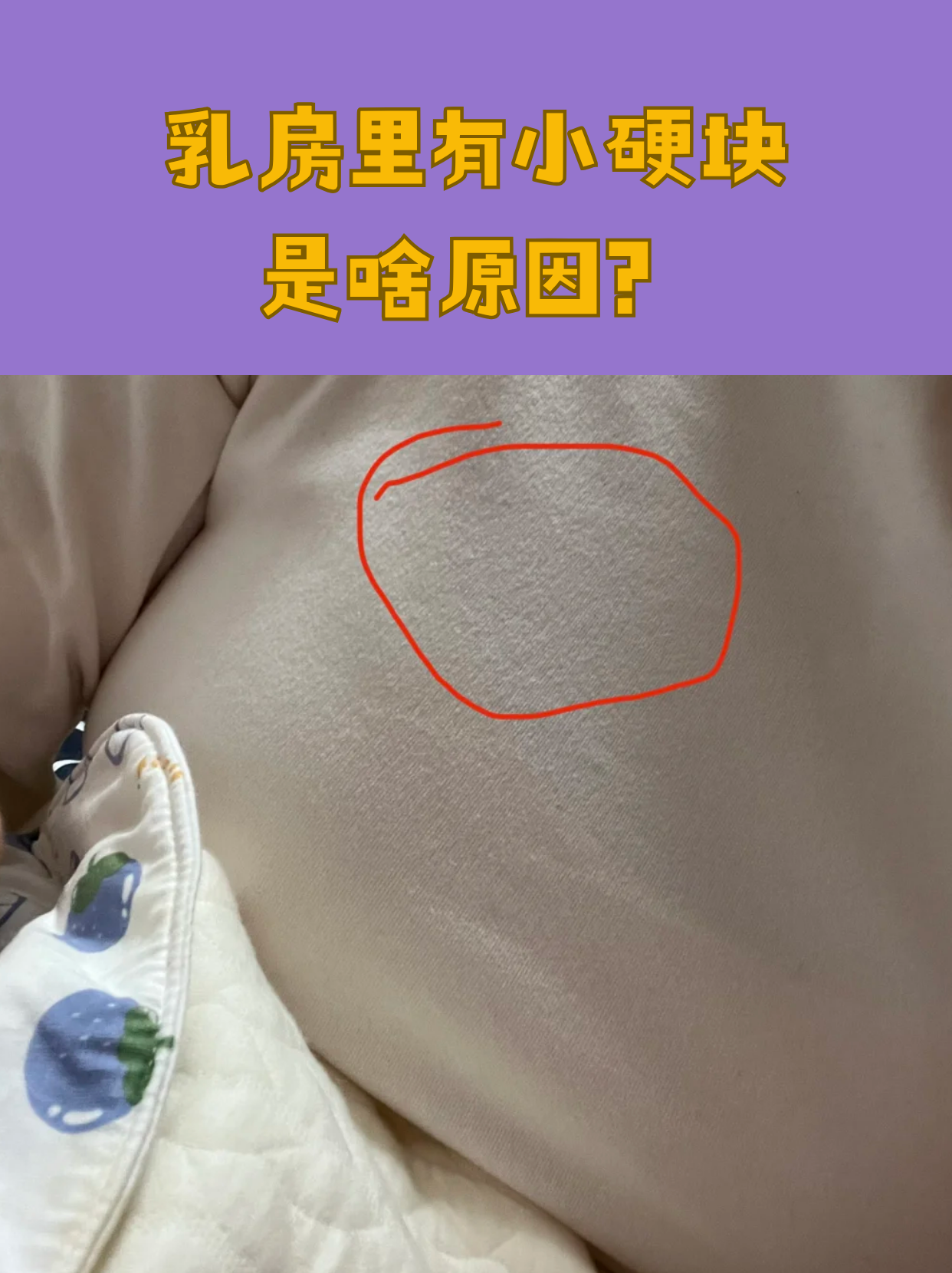 夏天穿得单薄时,不少女性会无意间摸到乳房有小硬块,这可能是正常的