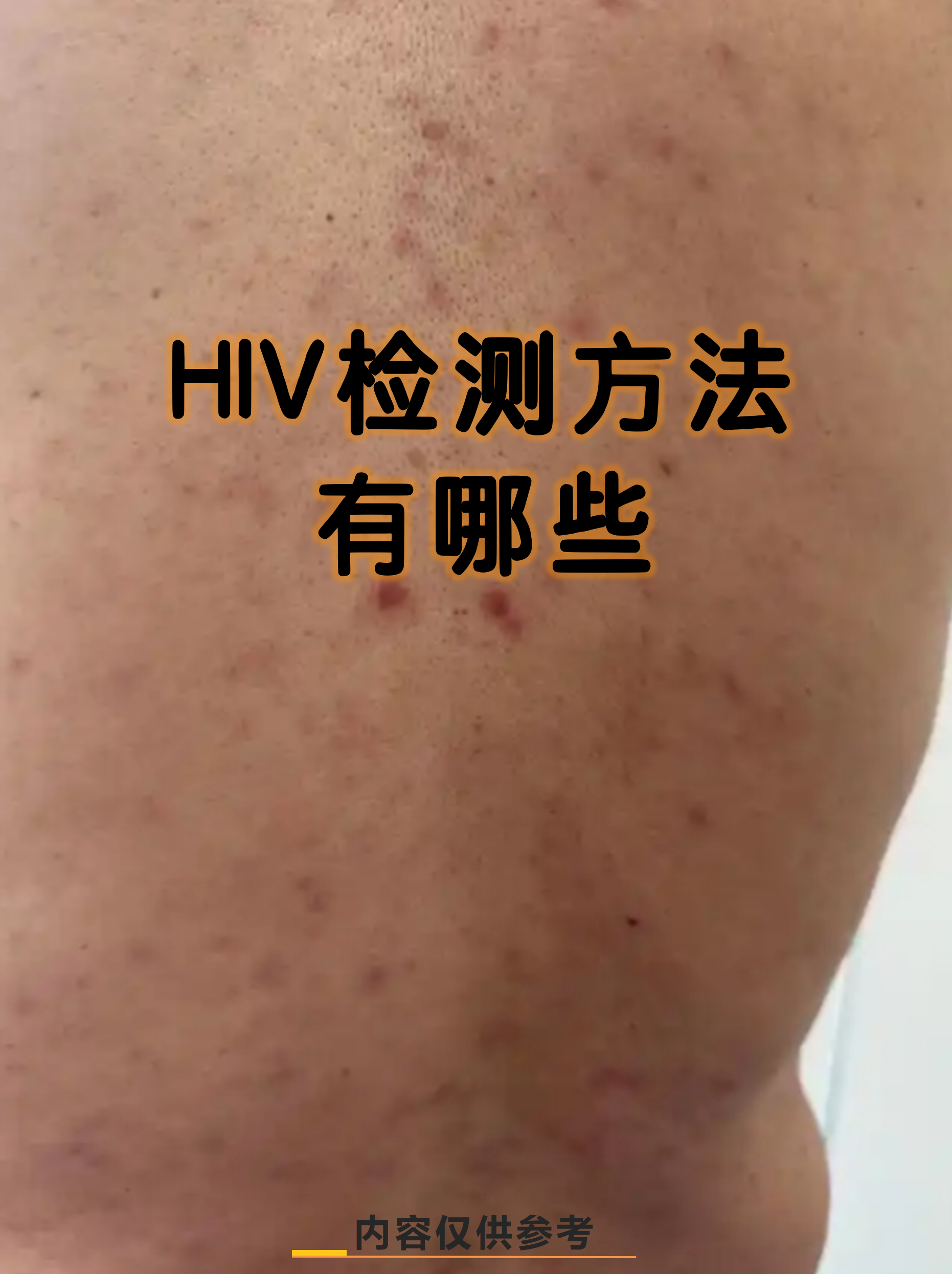 hiv检测是及时发现和防控艾滋病的重要手段,随着