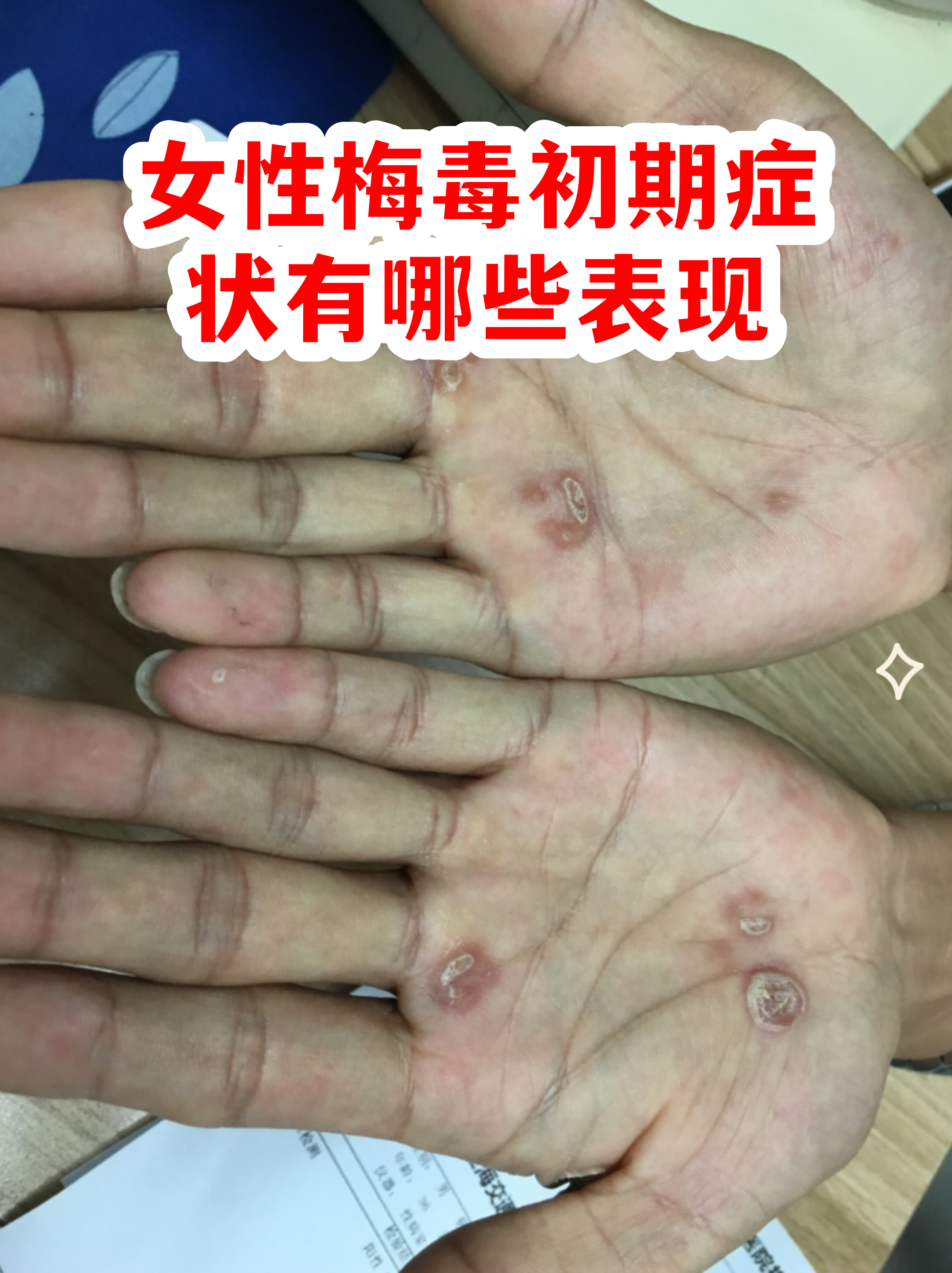 女性梅毒初期症状有哪些表现