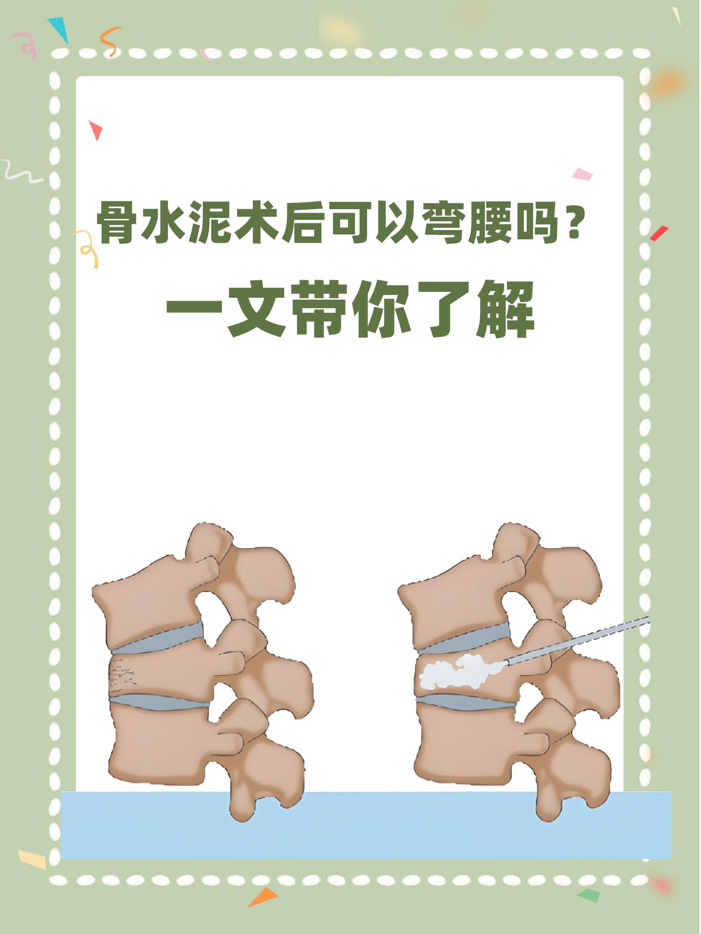 【骨水泥术后可以弯腰吗?