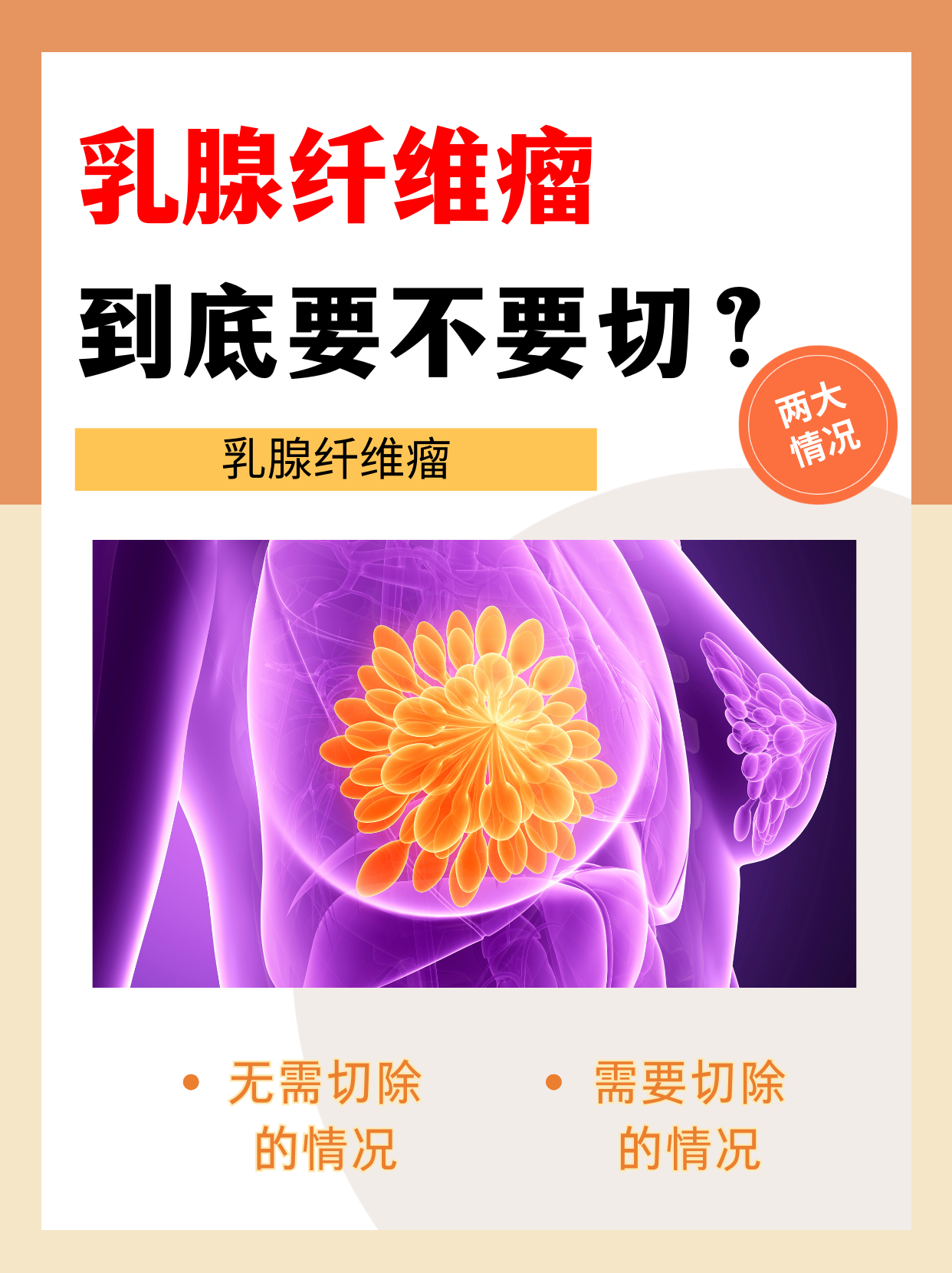 乳腺纤维瘤是乳腺组织中常见的良性肿瘤,主要由腺上皮和纤维组织两种