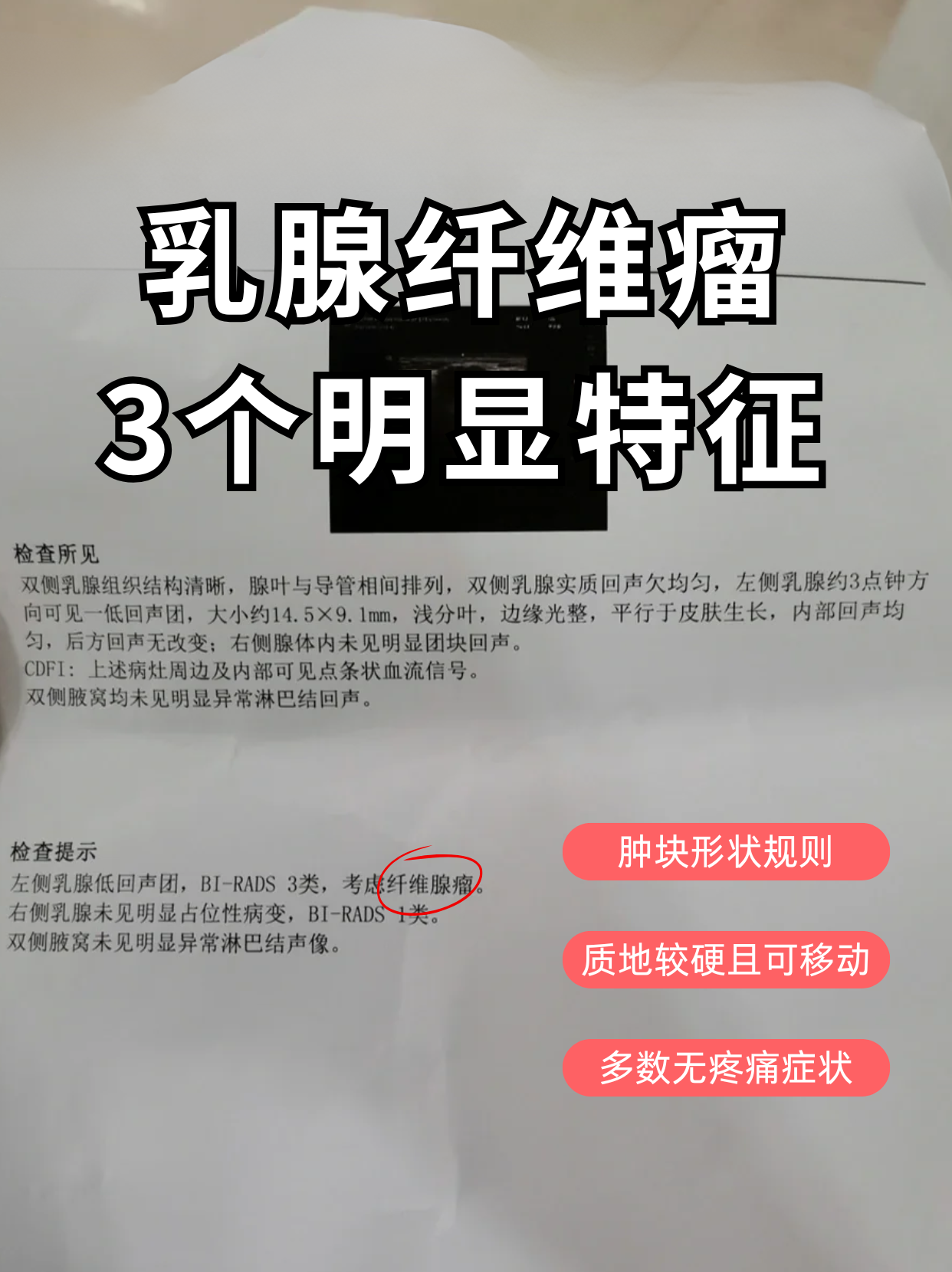乳腺纤维瘤是一种常见的乳腺良性肿瘤,主要由乳腺纤维细胞对雌妓刎