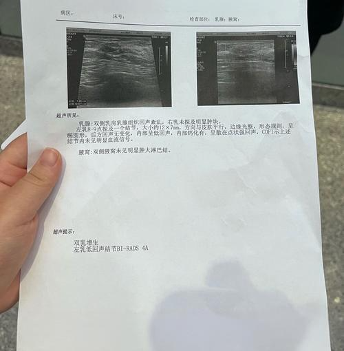 乳腺结节4a类是乳腺影像报告和数据系统