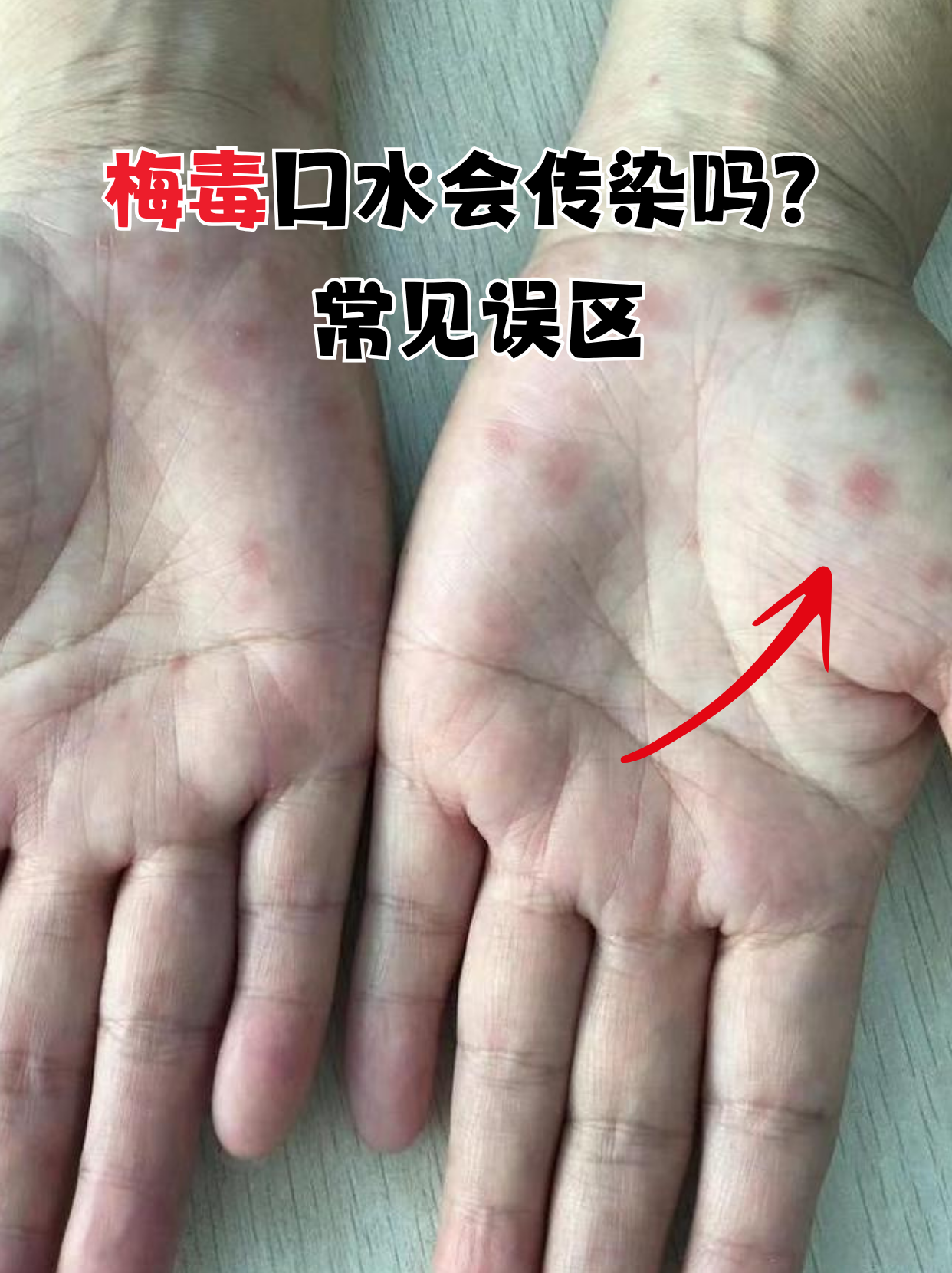 常见误区  和梅毒患者说话,吃饭,唾液接触会传染病毒?