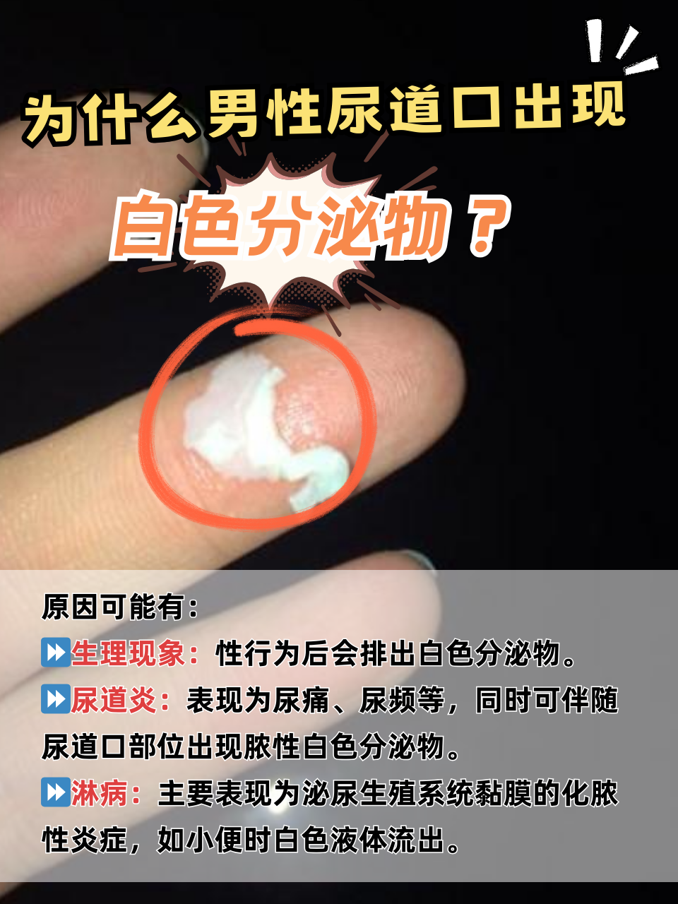 为什么男性尿道口出现白色分泌物?