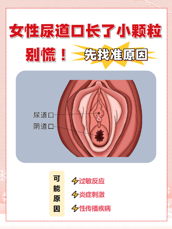 尿道口是女性泌尿系统的重要"门户",一旦出现问题,会给