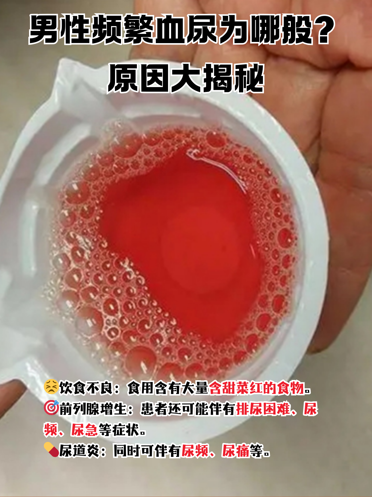 血尿,简单来说就是尿液中出现血液,这可不是个小问题