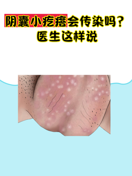 毛囊炎的症状和图片阴囊阴囊上面起了白色凸起小疙瘩蛋蛋上长疙瘩图片