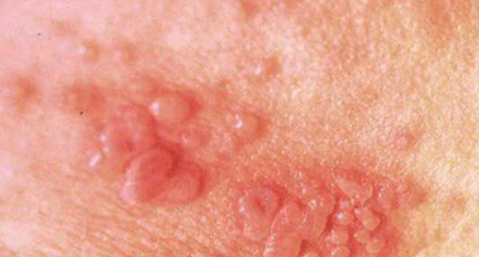 淋病是一种常见的性传播疾病,及时检查对治疗和预防