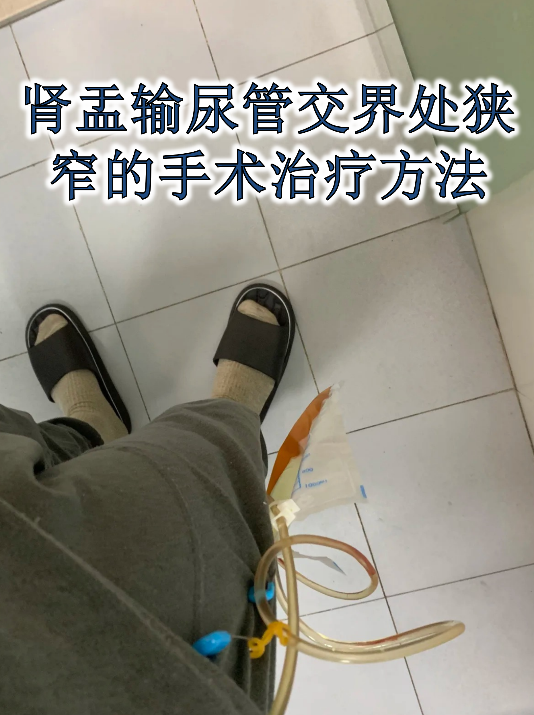 肾盂输尿管交界处狭窄的手术治疗方法