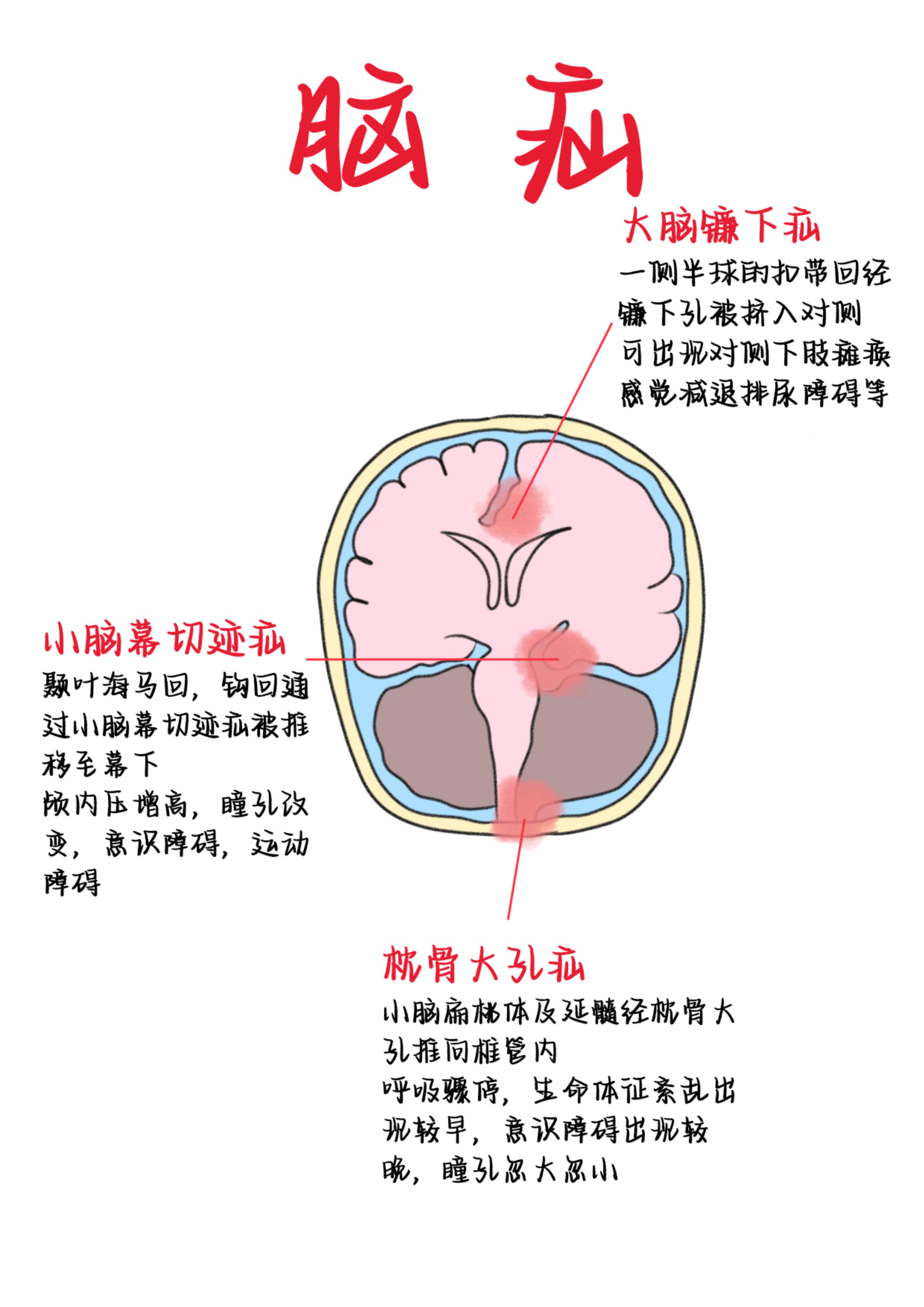 急性脑疝分类图片脑疝的图片及图解观察脑疝病人图片脑疝ct图片的解读