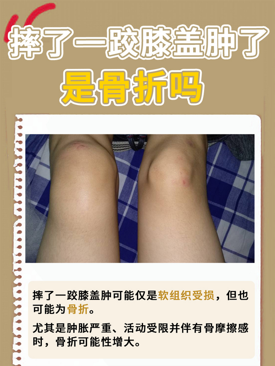 摔了一跤膝盖肿了是骨折吗 ,答案揭晓  08摔了一跤膝盖肿胀是膝盖的