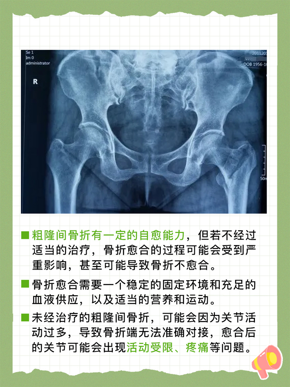 粗隆间骨折不管不顾,真的能自愈吗?