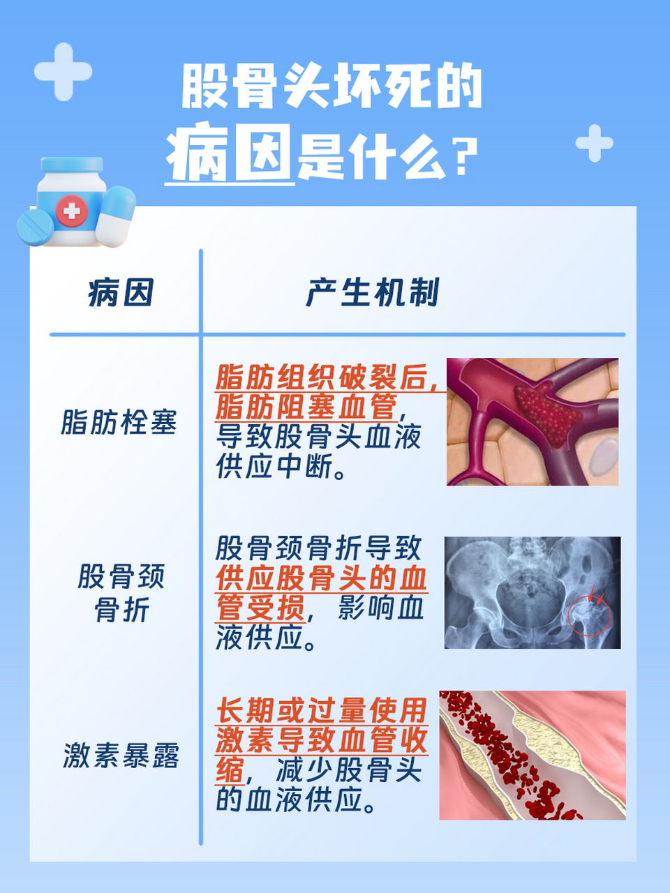 揭秘股骨头坏死治疗:吃什么药效果好一点?