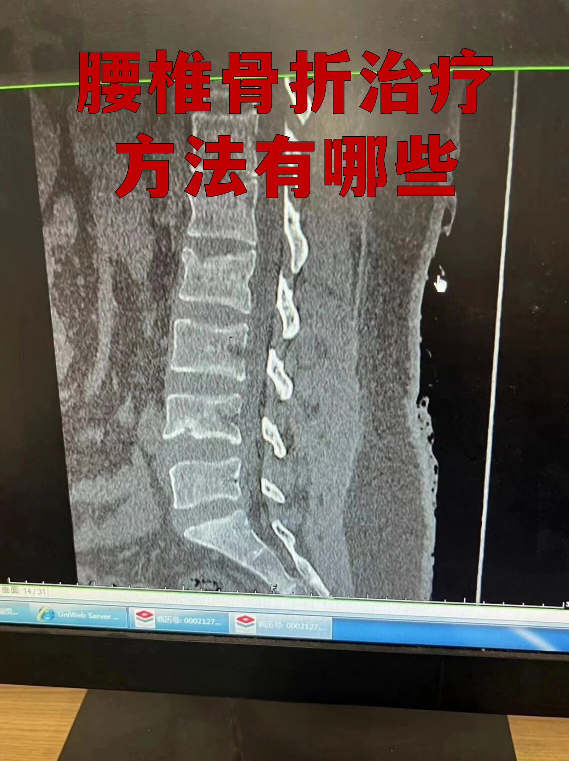 腰椎骨折治疗方法有哪些