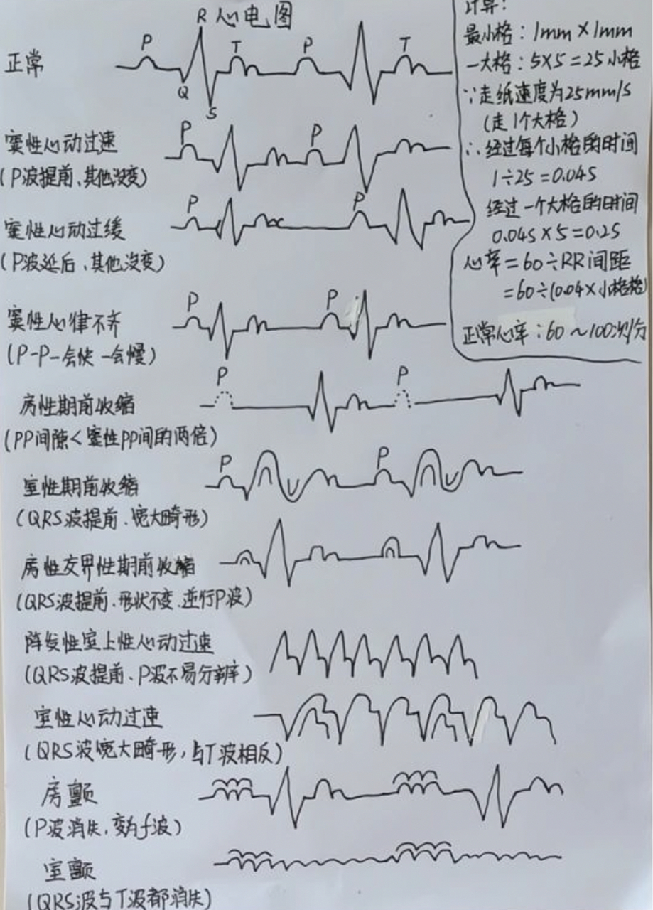 右心室心电图图片