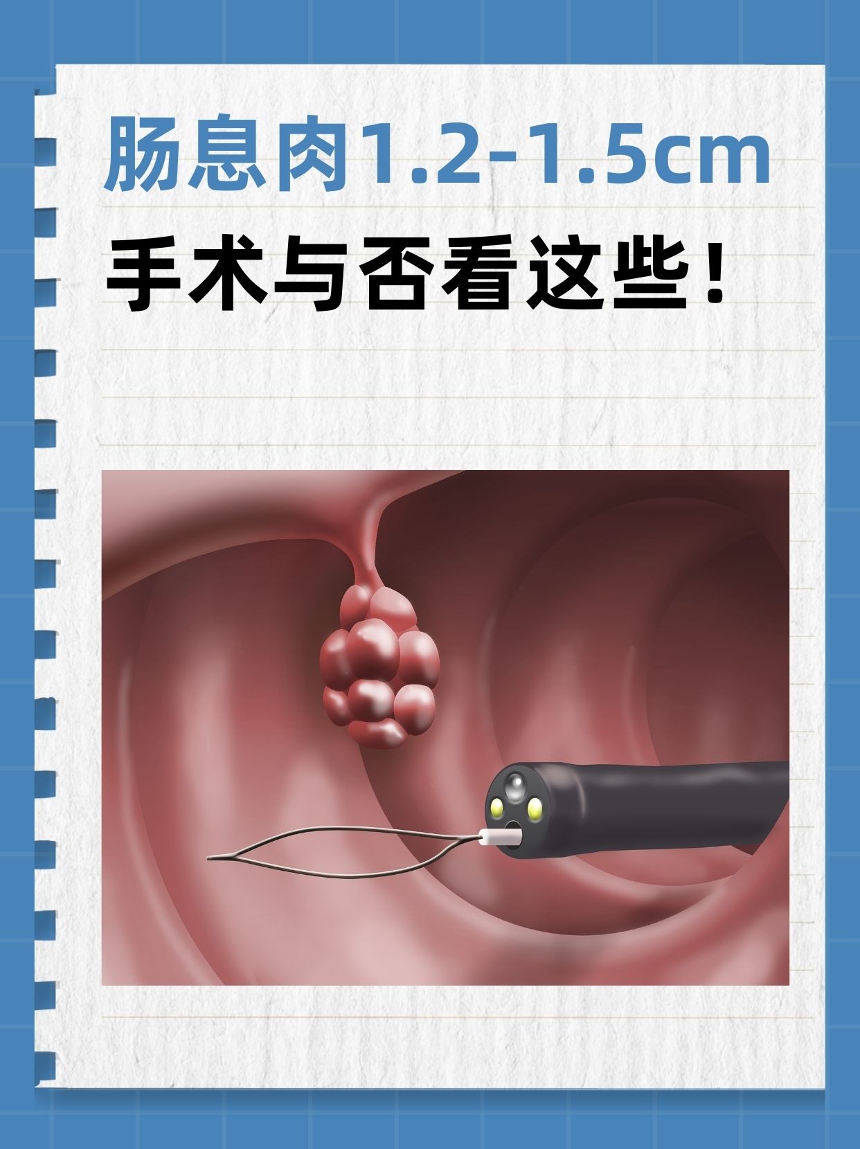 肠息肉是指肠黏膜表面突出到肠腔内的隆起状病变