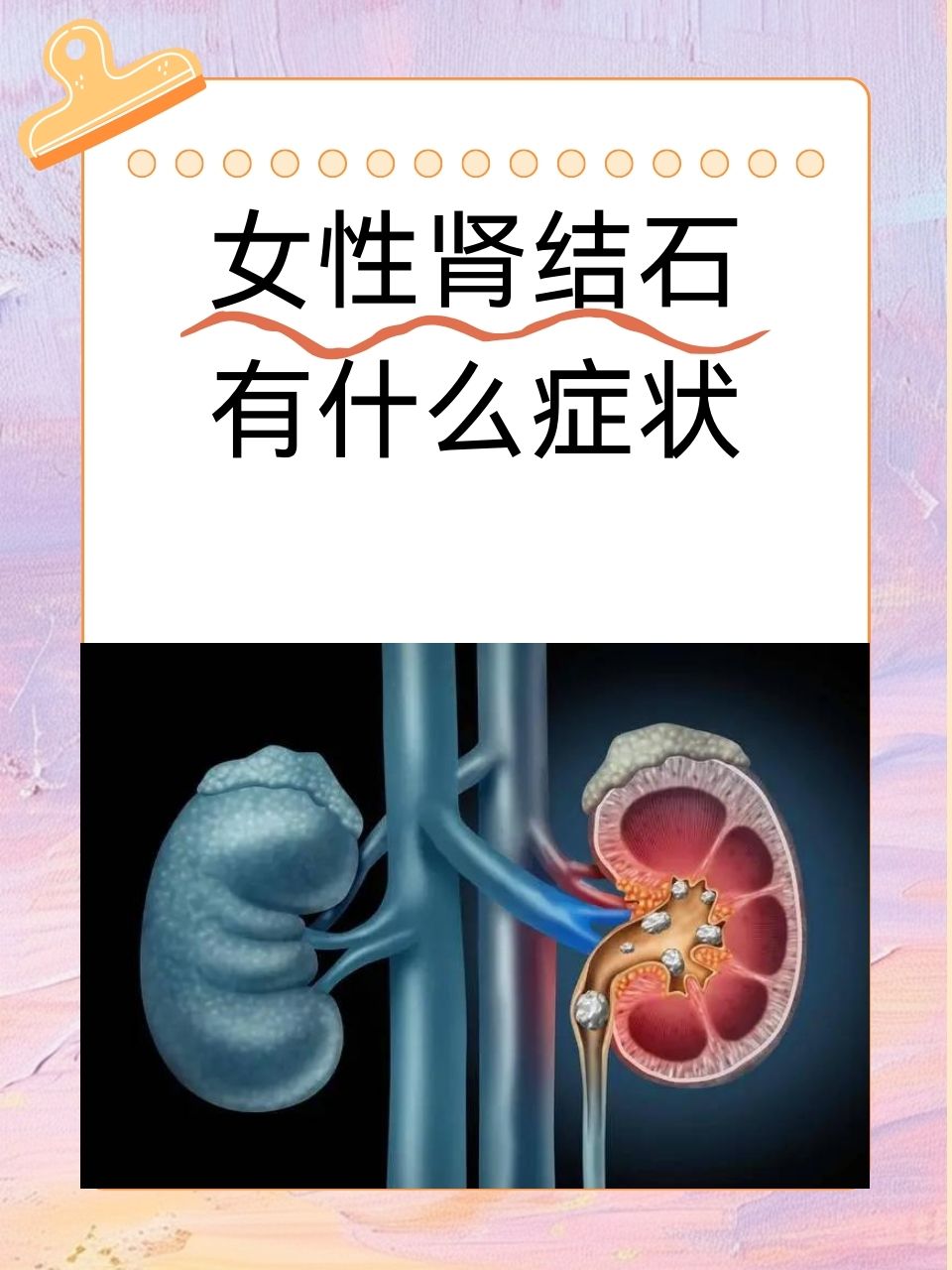 肾结石有什么症状图片